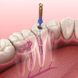 Root Canal Treatment