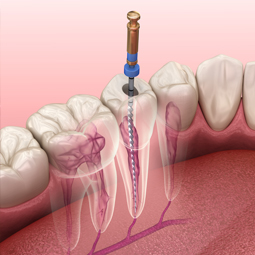 Root Canal Treatment